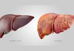 liver cirrhosis-ILBS